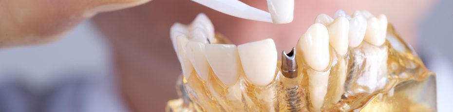 how to care for your dental implants