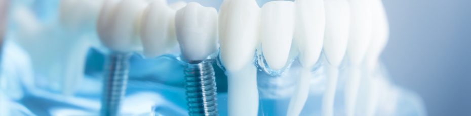 the steps to obtaining dental implants