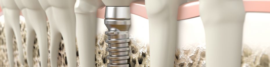 dental implants how long should they last