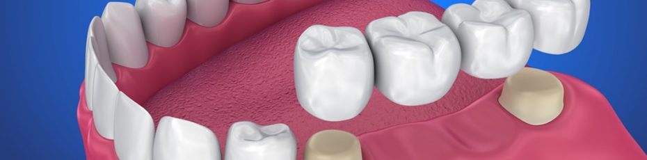 how do the dental bridges work