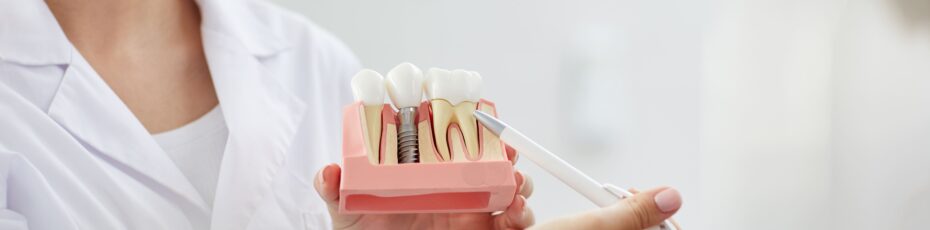 the underrated benefits of dental implants