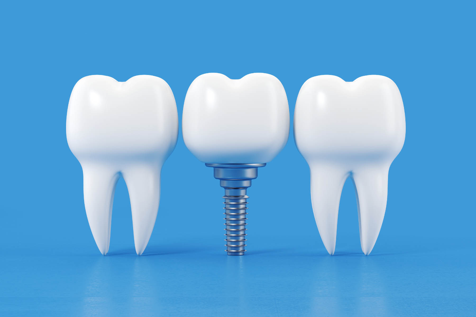 Dental Implant Procedure: Everything You Need to Know