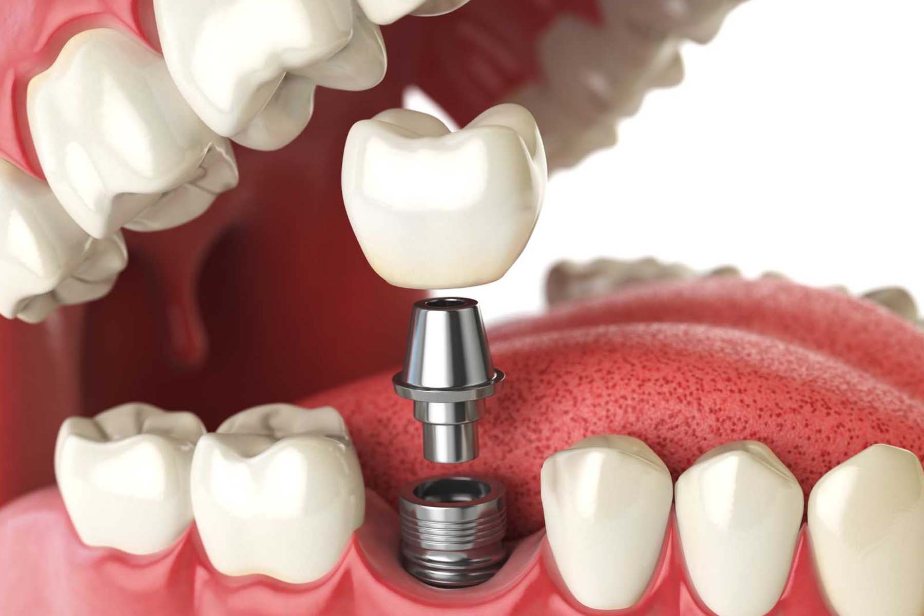 What Are the Benefits of Dental Implants?