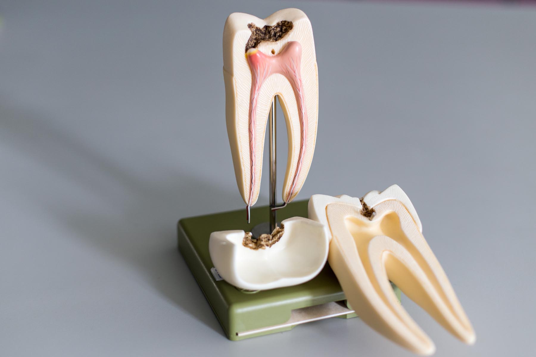 Will My Tooth Fall Out If I Don’t Get a Root Canal?